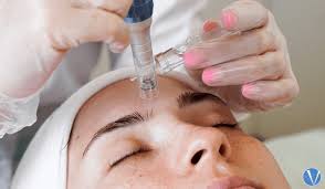 Medical Skin Needling / Radiofrequency ‘Skin tightening’ Facial